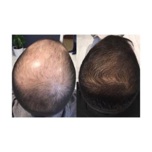 روغن و سرم مو اورجینال برند Borkaon مدل Hairon Plus Mavi Serum کد 363194440
