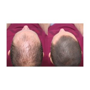 ست مراقبت از مو اورجینال برند Dermmatch مدل 45gr کد 175745095