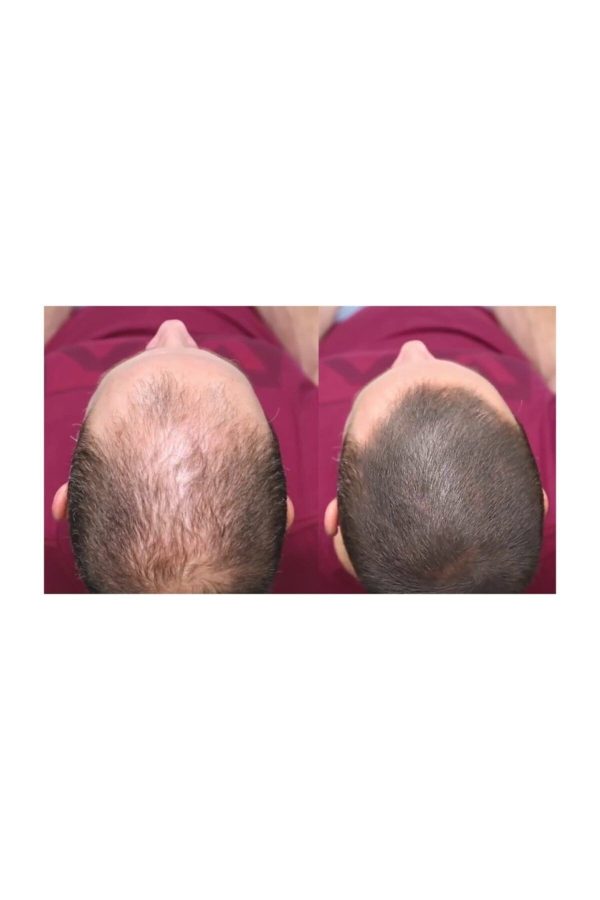 ست مراقبت از مو اورجینال برند Dermmatch مدل 45g کد 175612163 - Image 4